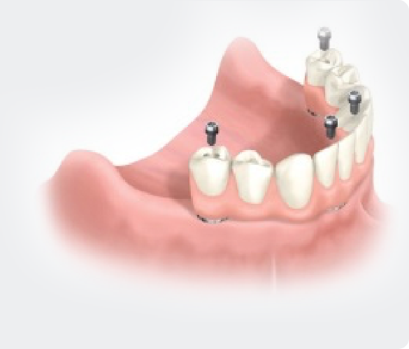 Family Dentistry of San Antonio all on four implants