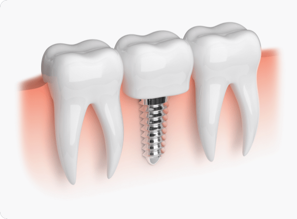 Family Dentistry of San Antonio dental implants