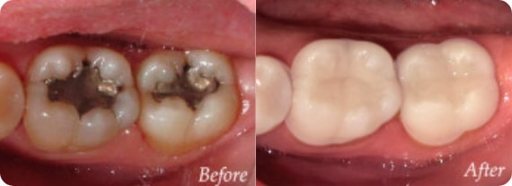 Family Dentistry of San Antonio tooth colored fillings before and after