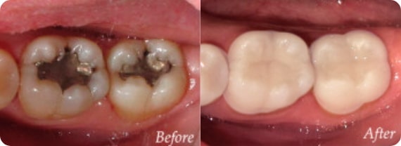 Dental Fillings Portland OR - Tooth-colored Composite Fillings