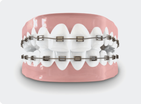 Family Dentistry of San Antonio what are braces